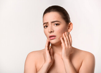 Young woman with acne problem on white background