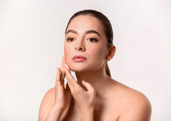 Young woman with acne problem on white background