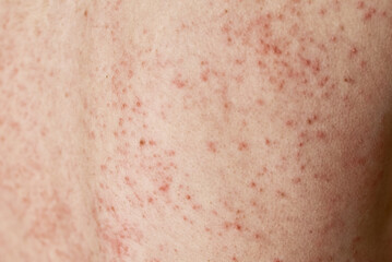 Fototapeta premium Allergic rash on skin. Woman with dermatology problem on back skin