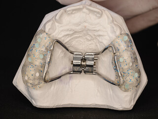 Appliance to make young upper jaw wider © rdonar