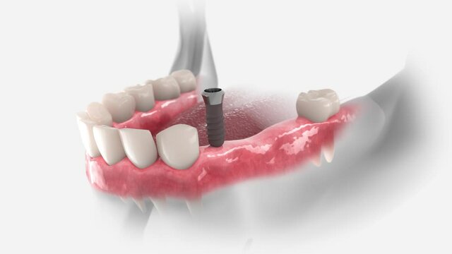 3D animation of dental restoration with dental bridge, supported by two implants.