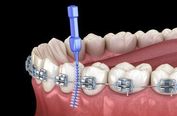 Interdental tooth brush and braces cleaning. Medically accurate 3D illustration of oral hygiene.