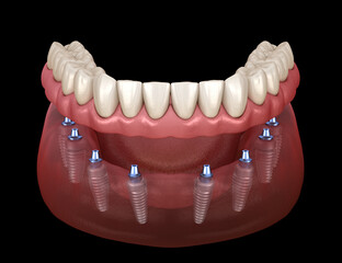 Mandibular prosthesis All on 8 system supported by implants. Medically accurate 3D illustration of human teeth and dentures concept