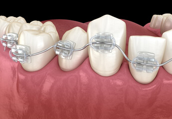 Abnormal teeth position and clear braces tretament. Medically accurate dental 3D illustration