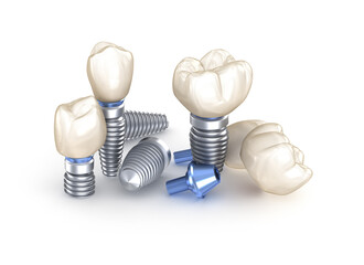 Dental Implants. 3D illustration concept of human teeth