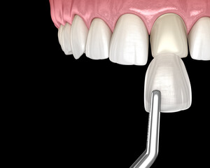 Dental Veneer installation procedure over central incisor. 3D illustration