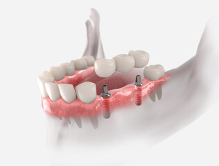 3d illustration of gums with dental bridge, supported by two implants