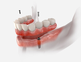 Fototapeta na wymiar Mandibular fixed restoration with two implants, posterior are tilted. 3D illustration of dental prosthesis on white background. Dental prosthetic innovation.