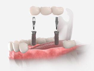 3d illustration of gums with dental bridge, supported by two implants. 