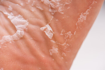 Fototapeta premium Skin peeling on the sole of a foot.