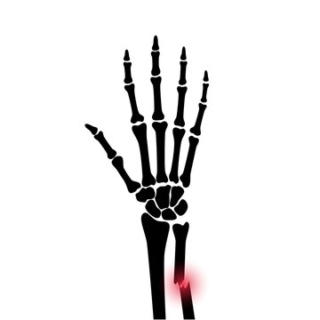Fracture x ray concept