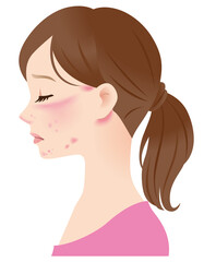 マスク皮膚炎　肌トラブルに悩む女性