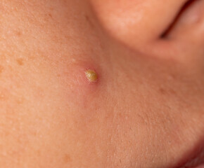 acne on the skin of the face as a background