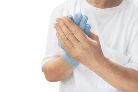 an old women Hands with beriberi on hand Disease causing inflammation of the nerves Beriberi in the elderly healthy concept