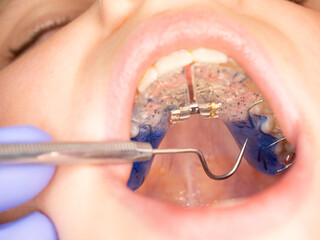 Check distance screw in expanding braces