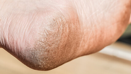 Man cracked heel. Dirt feet, cracked feet due to walking barefoot. 