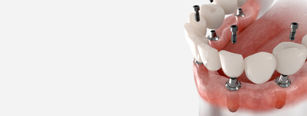 Restoration of mandible with 6 implants. 3D illustration of dental prosthesis on white background.