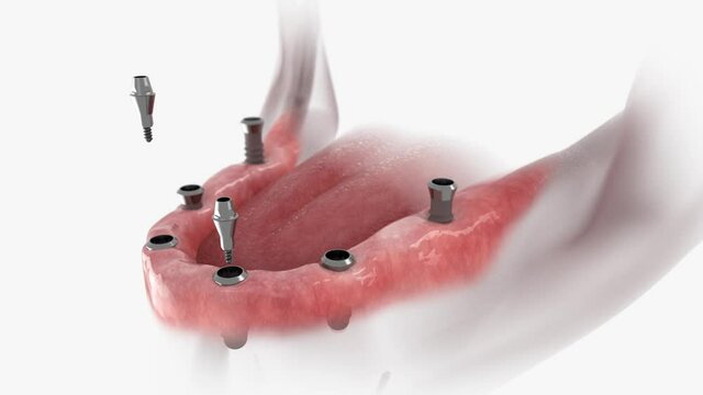 Restoration of mandible with 6 implants. 3D animation of installation dental prosthesis.