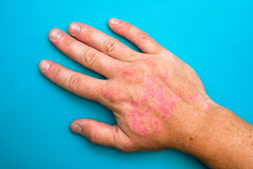 Burns of hand, wounds. Hand with sunburn. Type of burn