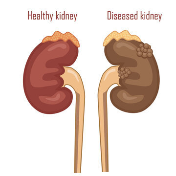 Human kidneys, excretory system. Sick and healthy kidneys, vector illustration