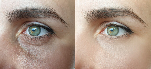 woman face wrinkles before and after treatment