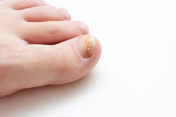 Close-up of toenail with fungus infection