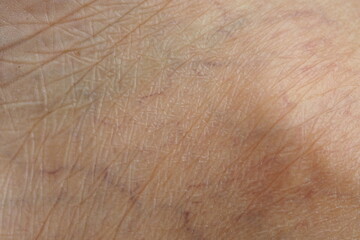 Closeup of wrinkles in skin in deep layers and varicose veins. Skin repair and treatment concept...