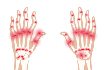 Obraz premium Arthrits x ray
