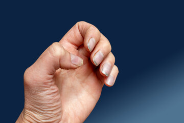Close-up of female caucasian hand with dirty brittle nails, broken nails on a blue background. Peeling on nails