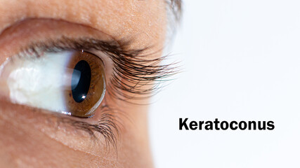 Macro eye photo. Keratoconus - eye disease, thinning of the cornea in the form of a cone. The...