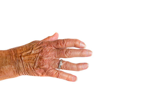 A brown hand with two silver rings of an elderly woman with Rheumatoid Arthritis disease on a white background.