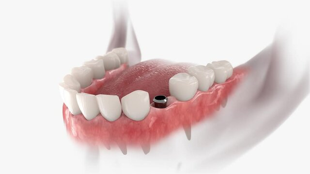 Instalation of dental crown, abutment and implant. 3D animation of human teeth and dentures on white background.
