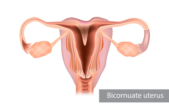 A bicornuate uterus or bicornate uterus is a type of mullerian anomaly in the human uterus