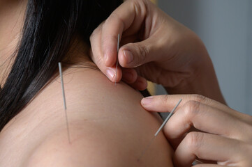 acupuncture young women.