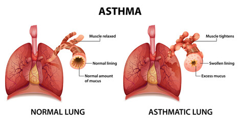 Comparison of healthy lung and Asthmatic lung
