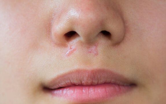 close-up keloids scars on face skin