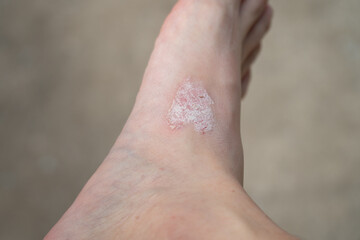 Close up dermatitis on the foot skin. Ill allergic rash eczema skin of patient.
