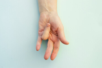 Hands of a woman with twisted fingers. Dupuytren's contracture disease.