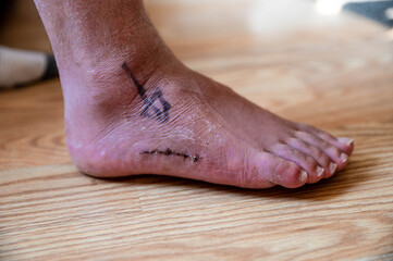 Close up of foot on wooden floor after removing cast after 6 weeks. close up on scar and skin detail with arrow showing where surgical cut was needed post op