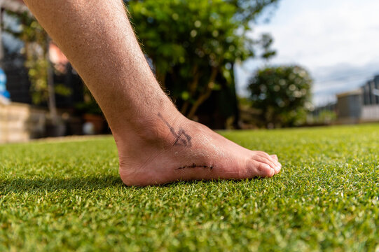 Close Up Of Foot On Grass Outside After Removing Cast After 6 Weeks. Close Up On Scar And Skin Detail With Arrow Showing Where Surgical Cut Was Needed Post Op