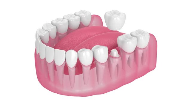 Jaw with dental crown embed on reshaped tooth over transparent background. Animation with luma matte. 