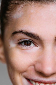 Closeup of a Woman with Vitiligo