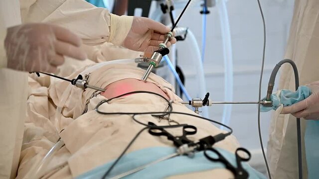 An assistant assists the surgeon with the operation Laparoscopic appendectomy
