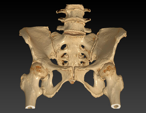 CT Scan of pelvic bone with both hip joint 3D rendering image Outlet  view .
