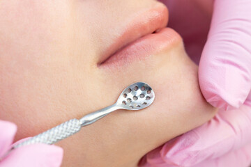 Procedure for cleaning the skin of the face with a steel appliance with a spoon from blackheads and acne.