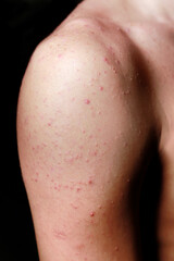 detalle de hombro con mucho acné en la piel