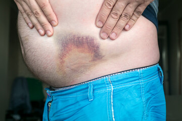 Bruise, hematoma on human body. Large bruise, bruise on the stomach of a man after injury.
