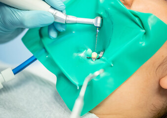 Treatment of dental canals in the bottom molar permanent mola…