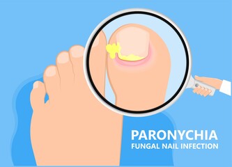 skin finger nail toes symptom injuries pus drain treatment treat fluid relieve heal wound fungal surgery hand feet Fungus felon onychia clubbing abscess thick ragged crack bed fungi Athlete's foot
