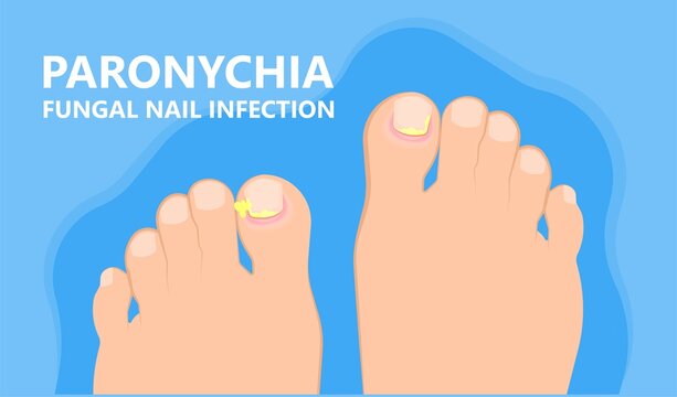 Skin Finger Nail Toes Symptom Injuries Pus Drain Treatment Treat Fluid Relieve Heal Wound Fungal Surgery Hand Feet Fungus Felon Onychia Clubbing Abscess Thick Ragged Crack Bed Fungi Athlete's Foot